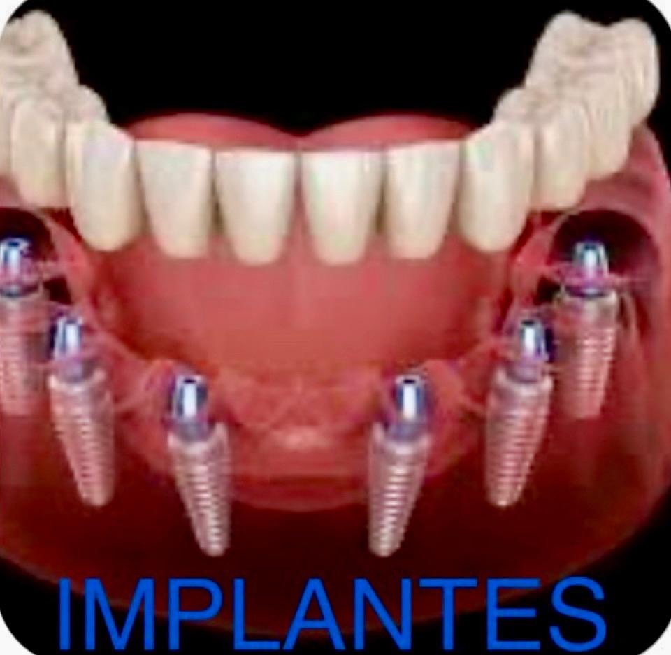 Servicio de implantes